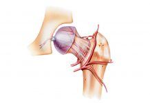 กระดูกสะโพกขาดเลือด