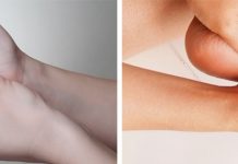 โรคปลายประสาทอักเสบ