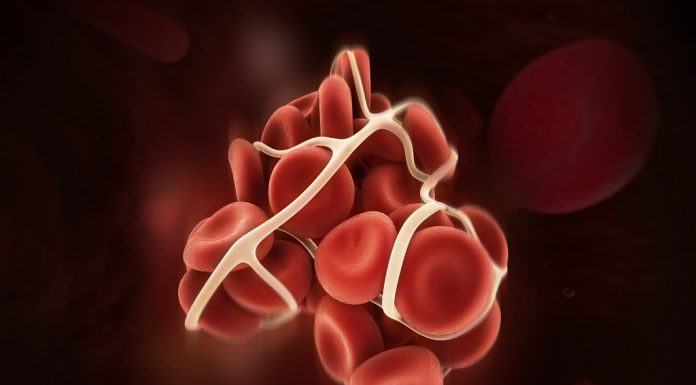 ลิ่มเลือดอุดตันปอด